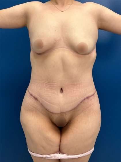 Tummy Tuck Before & After Patient #406