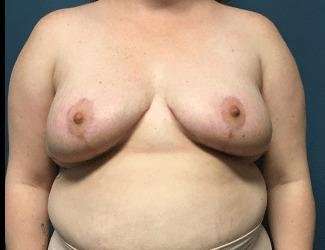 Breast Lift Before & After Patient #1934