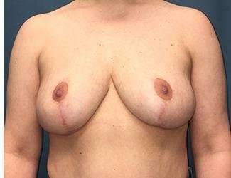 Breast Lift Before & After Patient #1945