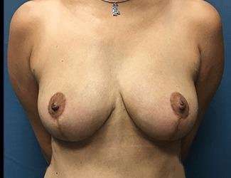Breast Lift Before & After Patient #1965