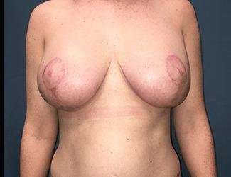 Breast Lift Before & After Patient #1978
