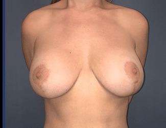 Breast Lift Before & After Patient #1989