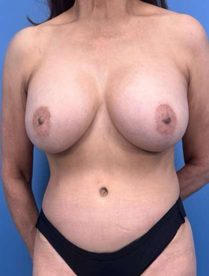 Breast Augmentation Before & After Patient #2027