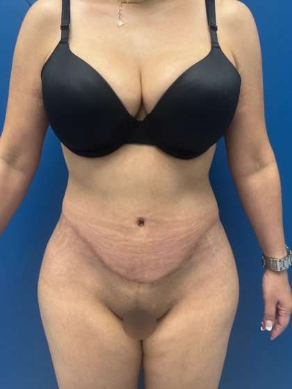 Tummy Tuck Before & After Patient #417