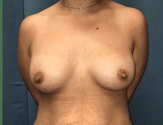 Breast Augmentation Before & After Patient #2091