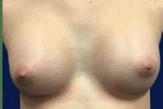 Breast Augmentation Before & After Patient #2102
