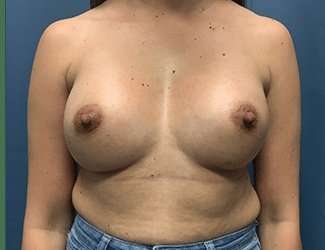 Breast Augmentation Before & After Patient #2133
