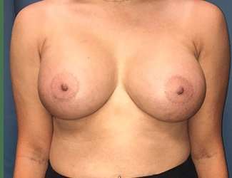 Breast Augmentation Before & After Patient #2144