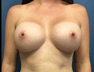 Breast Augmentation Before & After Patient #2191