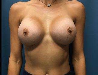 Breast Augmentation Before & After Patient #2202