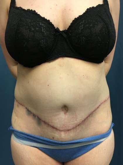 Tummy Tuck Before & After Patient #428