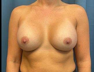 Breast Augmentation Before & After Patient #2231