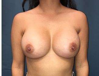 Breast Augmentation Before & After Patient #2242