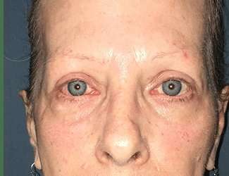 Blepharoplasty Before & After Patient #2271