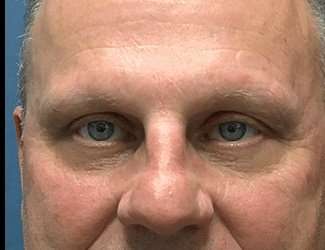 Blepharoplasty Before & After Patient #2282