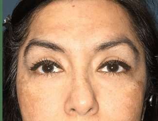 Blepharoplasty Before & After Patient #2293