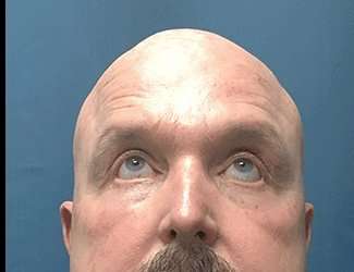 Blepharoplasty Before & After Patient #2328