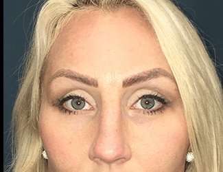 Blepharoplasty Before & After Patient #2339