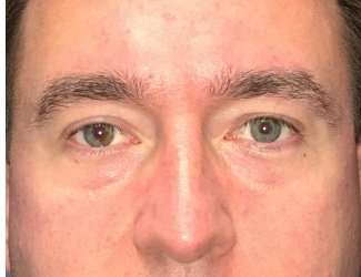 Blepharoplasty Before & After Patient #2352