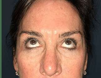 Blepharoplasty Before & After Patient #2368