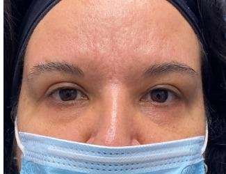 Blepharoplasty Before & After Patient #2385