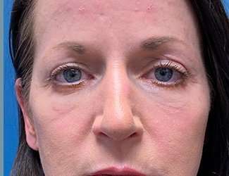 Blepharoplasty Before & After Patient #2408