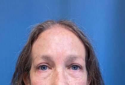 Blepharoplasty Before & After Patient #2419