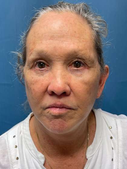 Blepharoplasty Before & After Patient #2430