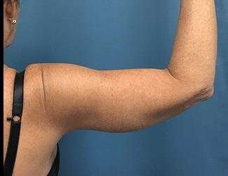 Arm Lift Before & After Patient #2461