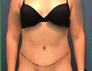 Tummy Tuck Before & After Patient #457