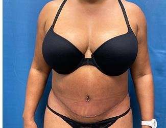 Tummy Tuck Before & After Patient #468