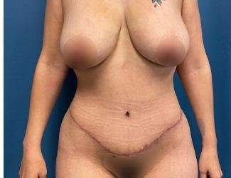 Tummy Tuck Before & After Patient #493