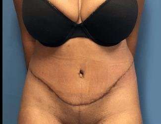 Tummy Tuck Before & After Patient #504