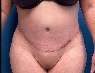 Tummy Tuck Before & After Patient #515