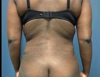 Tummy Tuck Before & After Patient #528