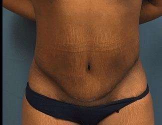 Tummy Tuck Before & After Patient #546