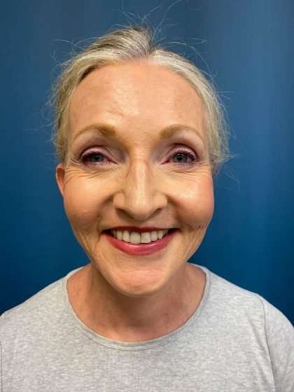 Submentoplasty Before & After Patient #654