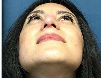Rhinoplasty Before & After Patient #667