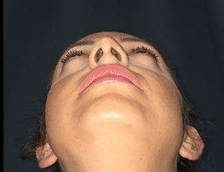 Rhinoplasty Before & After Patient #680