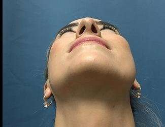 Rhinoplasty Before & After Patient #706