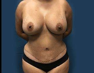 Mommy Makeover Before & After Patient #743