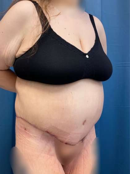 Lower Body Lift Before & After Patient #1021