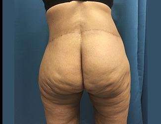 Lower Body Lift Before & After Patient #1047