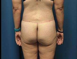 Lower Body Lift Before & After Patient #1114