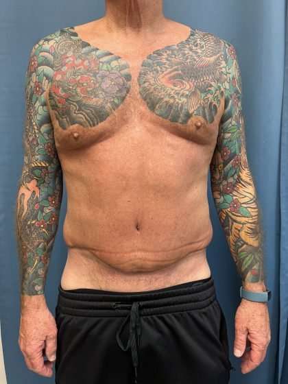 Tummy Tuck Before & After Patient #322