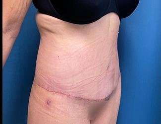 Lower Body Lift Before & After Patient #1127