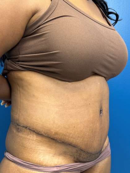 Lower Body Lift Before & After Patient #1154