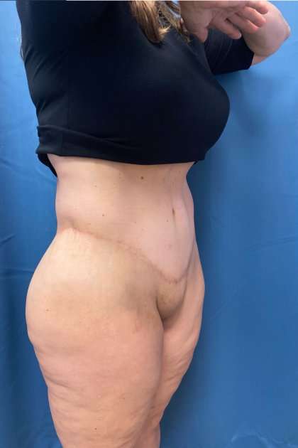 Lower Body Lift Before & After Patient #1174