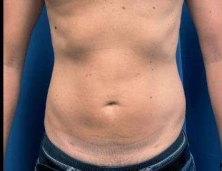 Liposuction Before & After Patient #1257