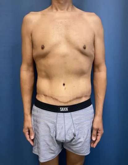 Tummy Tuck Before & After Patient #333